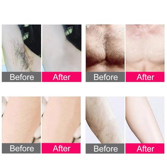 IPL Laser Hair Removal Handset for Painless Permanent Hair Reduction - Aroflit