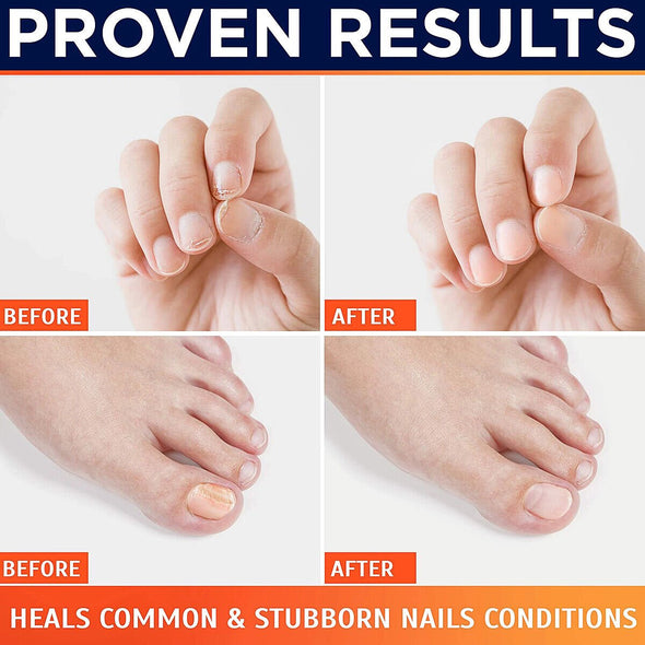 Revolutionary Nail Fungus Laser Device for Fast and Pain - Free - Aroflit