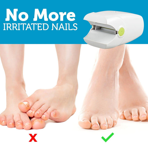 Revolutionary Nail Fungus Laser Device for Fast and Pain - Free - Aroflit
