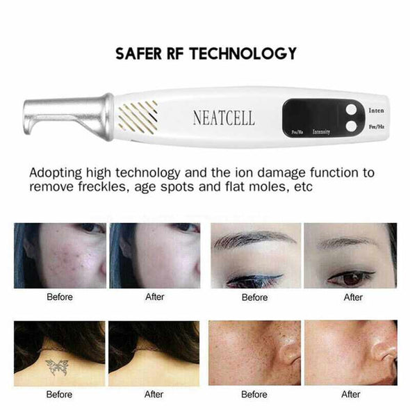 SkinRenu™ Laser Pen Tattoo Removal - Aroflit