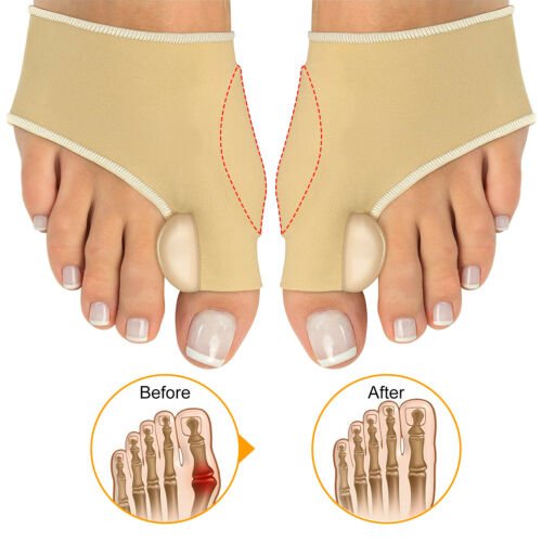 Corby™ - Non - Surgical Hallux Valgus Correction - Aroflit