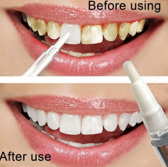 Perfect Teeth Whitening Pen - Aroflit